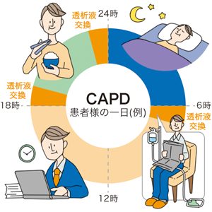 CAPD（連続携行式腹膜透析）における患者様の1日の流れ（24時間の中で透析液交換を3〜5回行うイメージ）