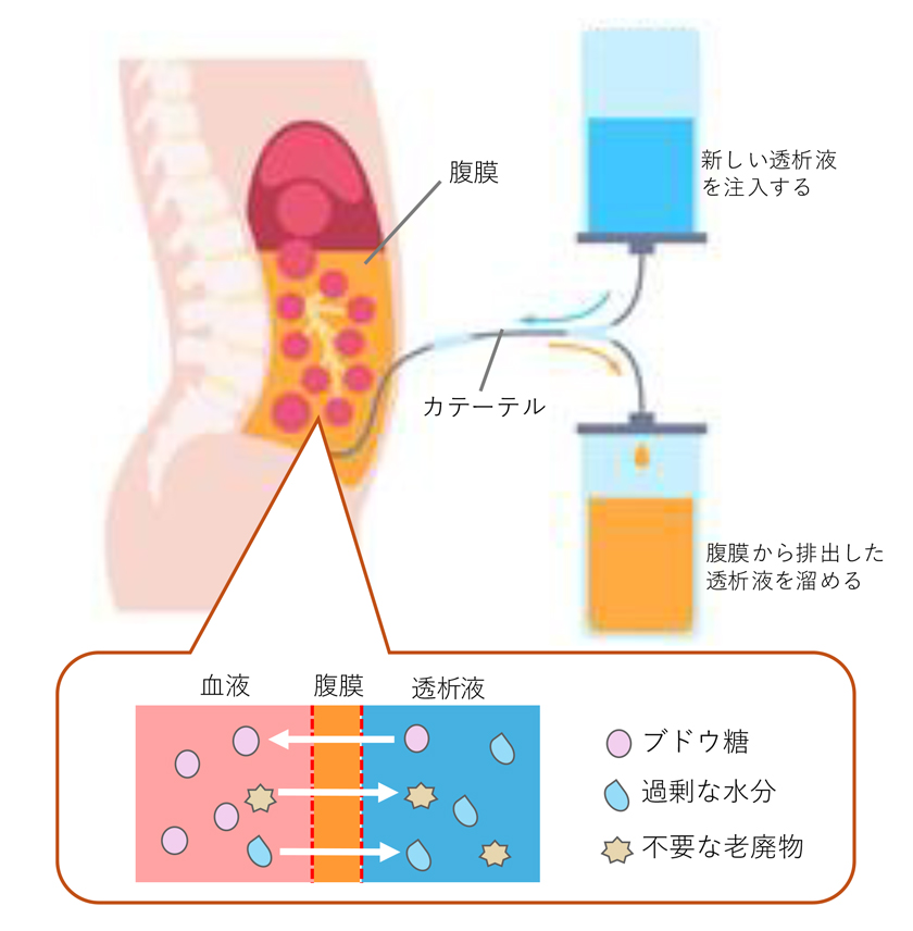 腹膜透析の仕組み図（腹膜・カテーテル・透析液の流れと、血液から腹膜を通して老廃物が透析液に移動するイメージ）